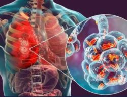 Pemkab Bojonegoro Sosialisasi Bahaya Penyakit Pneumonia di Musim Pancaroba
